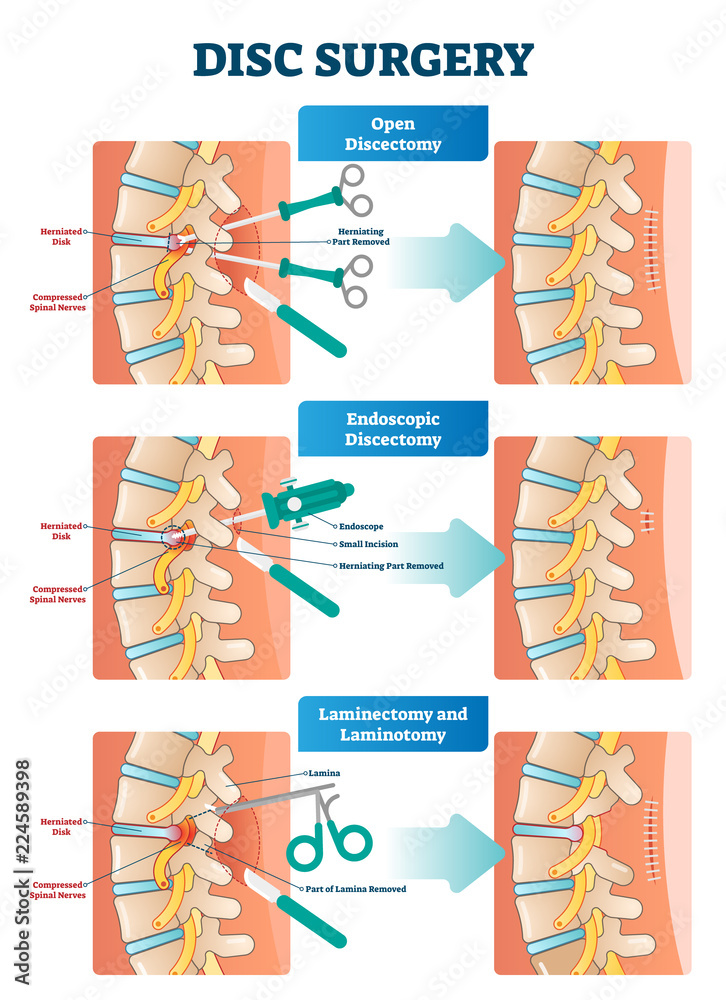 Canvas Prints Disc surgery vector illustration. Diagram with back nerves and bones pain.