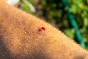 Bruised wound injury on man knee background.