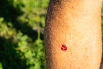 Bruised wound injury on man knee background.