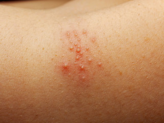 Close up of girl has rash and other nonspecific skin eruption on her shoulders. May be caused by...