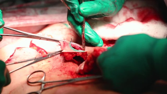 Plastic surgeon performs an operation for abdominoplasty with a transfer of the navel
