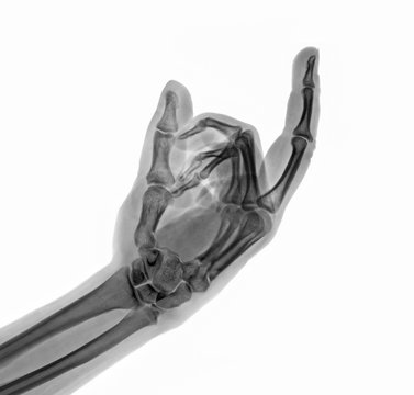 X-ray hand showing a middle finger sign