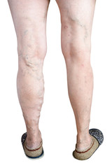 Ugly sick legs of an old woman on a white background.