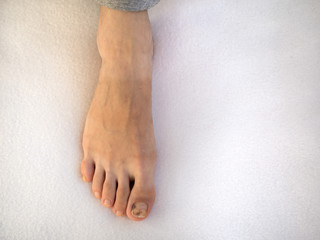 Bruise on the toe of the foot. Foot problems.
