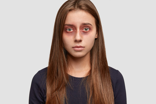 Headshot of attractive brunette woman with bruises around eyes, beat by aggressive husband, looks with miserable expression directly at camera, poses over white studio background. Victim of abuse