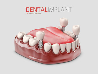 3d illustration of Human Dental implant isolated gray - obrazy, fototapety, plakaty