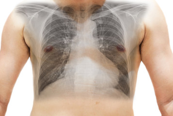 Close up Human chest with x-ray show Cardiomegaly. Isolated background . Blank area at middle side.