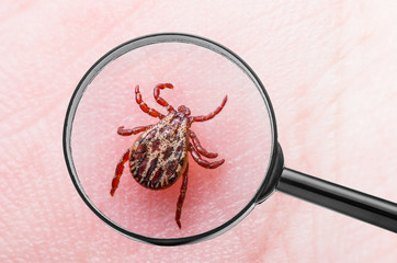 Encephalitis Virus or Lyme Disease Infected Tick Arachnid Insect on Skin with Loupe Magnification