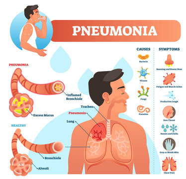 Pneumonia vector illustration. Labeled diagram with causes and symptoms.