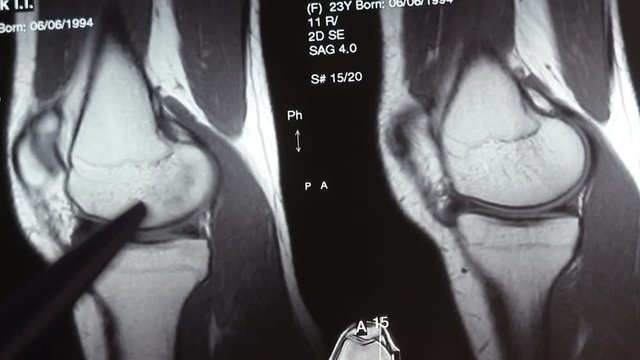 Doctor examining a patient's tonogram with a diseased knee joint