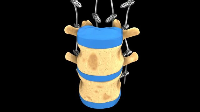 Part of the human spine with fixators animated