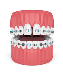 3d render of teeth with diastema and braces