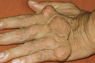 Severe gout in men suffering from joint pain, bone pain, gout, rheumatoid symptoms, radioactive...