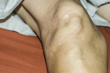 Severe gout in men suffering from joint pain, bone pain, gout, rheumatoid symptoms, radioactive sickness, ill man concept of male osteoporosis, injured bone, injury, pain, arthritis,arm, foot, knee