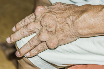 Severe gout in men suffering from joint pain, bone pain, gout, rheumatoid symptoms, radioactive sickness, ill man concept of male osteoporosis, injured bone, injury, pain, arthritis,arm, foot, knee