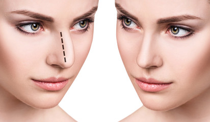 Female face before and after cosmetic nose surgery. - obrazy, fototapety, plakaty
