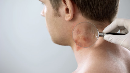 Therapist examines rash on patient neck with magnifying glass, dermatology - obrazy, fototapety, plakaty