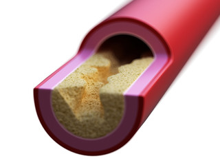 3d rendered illustration of a blocked artery