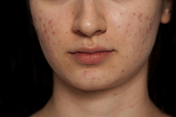 closeup of teenage girl with problematic skin on black background
