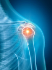 3d rendered medically accurate illustration of a painful shoulder