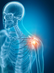 3d rendered medically accurate illustration of a painful shoulder