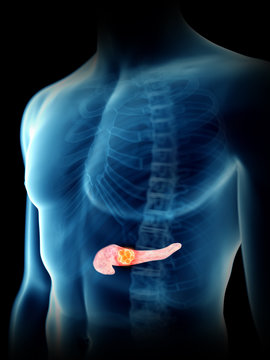 3d rendered medically accurate illustration of a mans pancreas tumor