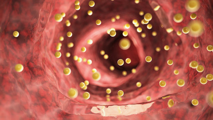 3d rendered medically accurate illustration of colon inflammation caused by gluten - obrazy, fototapety, plakaty