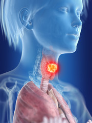 3d rendered medically accurate illustration of a womans thyroid gland cancer