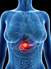 3d rendered medically accurate illustration of a womans pancreas cancer - obrazy, fototapety, plakaty
