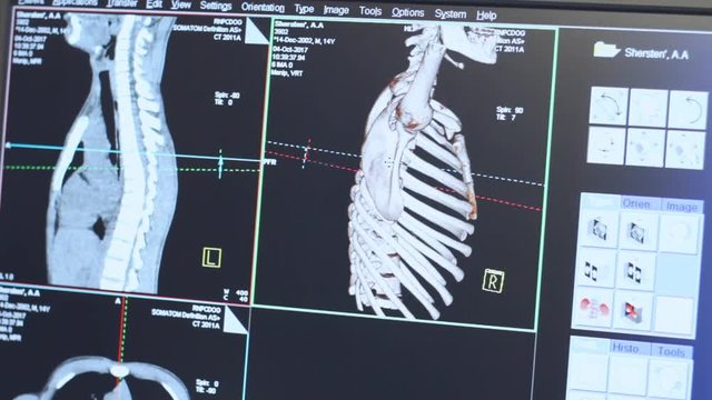 Tomography scan of human rib cage on monitor. High technology radiography expertise. Computed tomography x-ray image in medical centre. Medicine equipment and healthcare. Medical examination procedure
