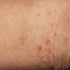 Fototapeta premium Rash on sensitive skin, skin problem with allergy rash, soft focus