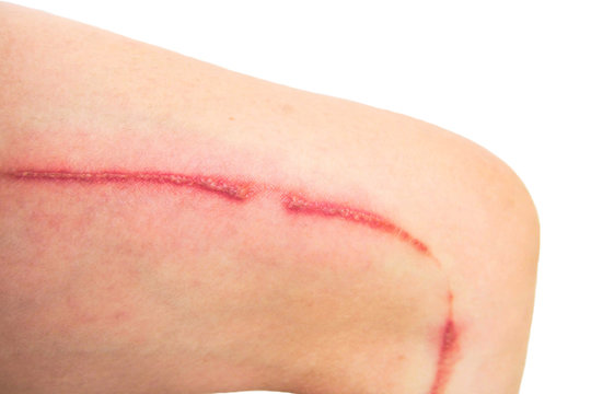 Blisters caused by rove beetles (Paederus fuscipes Curtis) on thigh. Very long wound on leg. Skin allergy or insect bites from bug poison. isolated on white background.