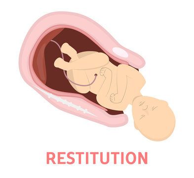 Restitution Stage Of Baby Birth In Vaginal Delivery