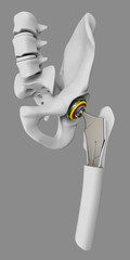 Hip joint replacement, artificial joint isolated gray 3d Illustration
