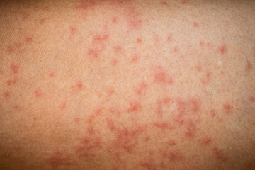rash skin