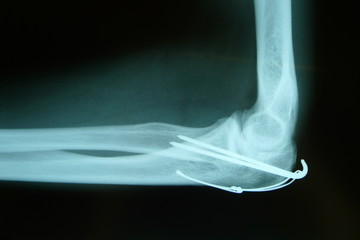 Cerclage Ellenbogen