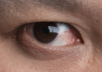 Fototapeta premium Human's red eye conjunctivitis