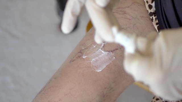 Middle aged woman rubbing numbing cream on her leg with varicose veins to prepare for her home antibiotic infusion treatment.