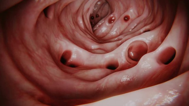 Diverticulosis in large intestine, animation