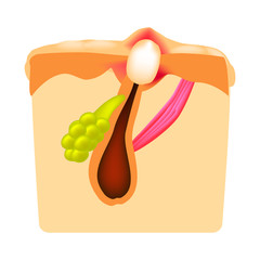 Closed comedones. white heads acne. The structure of the skin. Infographics. Vector illustration on isolated background