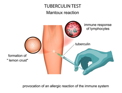 tuberculin test. mantoux