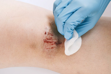 Close-up of bloody gash on knee. Wound treatment with antiseptic