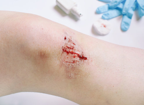 Close-up of bloody gash on knee. Wound treatment with antiseptic