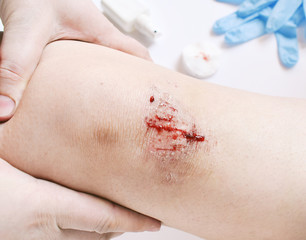 Close-up of bloody gash on knee. Wound treatment with antiseptic