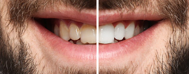 Smiling man before and after teeth whitening procedure, closeup