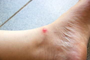 Red spot on Asian woman skin. Insect Sting Allergy. Health and medical background.