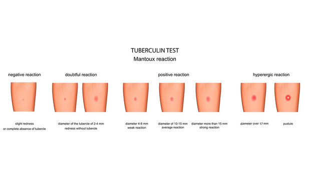 vector illustration of the assessment of reaction to a Mantoux test