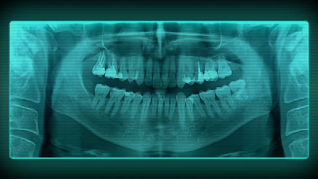 Panoramic dental X-ray