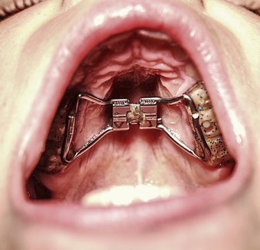 Kid wearing orthodontic palatal expanding trainer.  Birth dental deffect