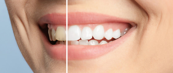 Smiling woman before and after teeth whitening procedure, closeup